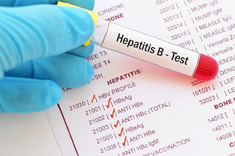 Xét nghiệm HBsAg có chỉ số 5561, trạng thái Reactive có khả năng bị nhiễm viêm gan B chưa?