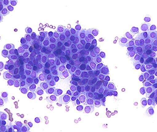 Hình ảnh các tế bào ung thư trên tiêu bản