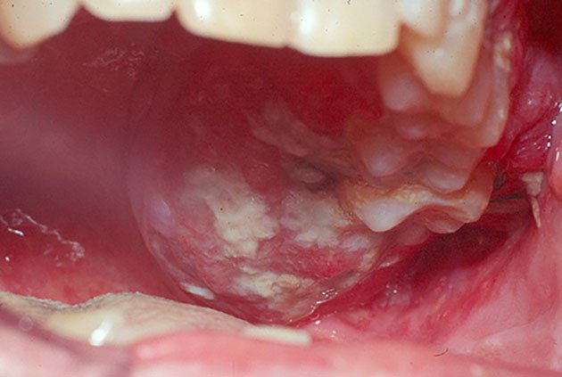 Loét miệng ở khe liên hàm hơn 2 tuần không khỏi có phải ung thư khoang miệng không?