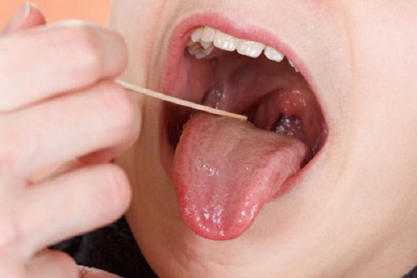 Đau rát lưỡi, họng kèm nổi cục cứng ở hàm dưới là dấu hiệu bệnh gì?