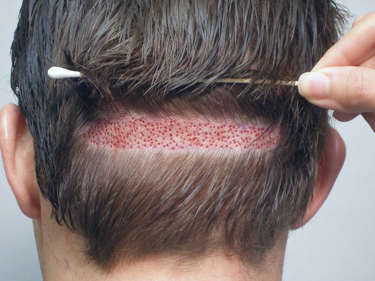 Bạn có thể sử dụng phương pháp cấy tóc điều trị rụng tóc bất thường