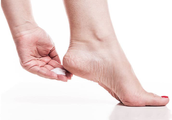 Bạn nên bảo vệ gót chân tránh tình trang nứt gót chân