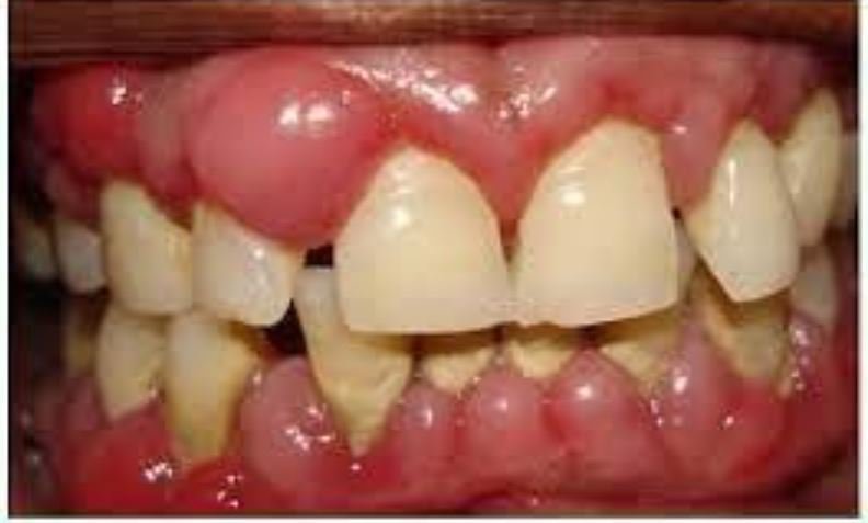 Nhiều cao răng, lợi ở các kẽ răng sưng, phì đại và chảy máu.