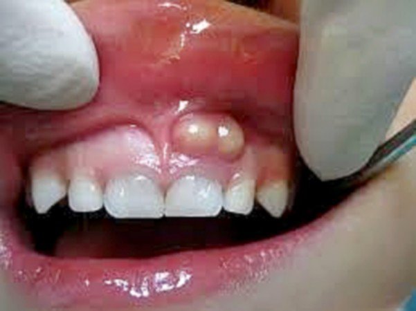 Abscess cuống răng