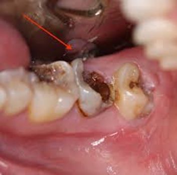 Răng khôn mọc lệch ra má gây sâu răng khôn và các răng kế cận