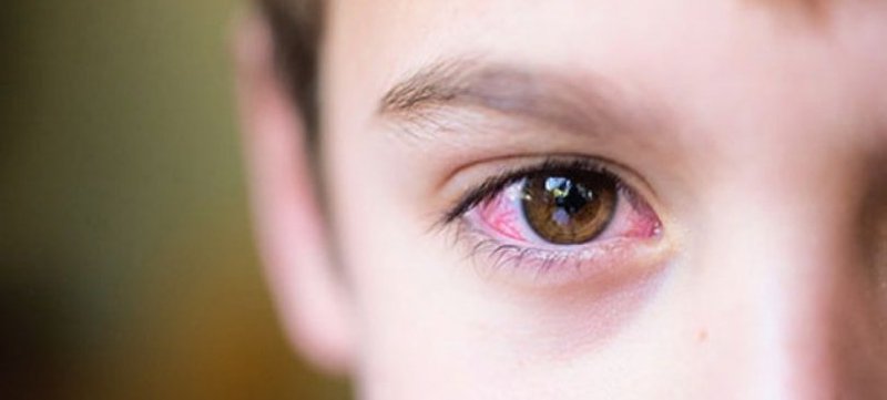 Trẻ 7 tuổi bị ngứa đỏ mắt kèm ra ghèn xanh có phải viêm kết mạc dị ứng không?