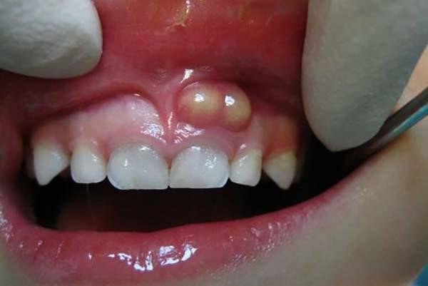 Sưng nướu răng có gây đau tai phải không?