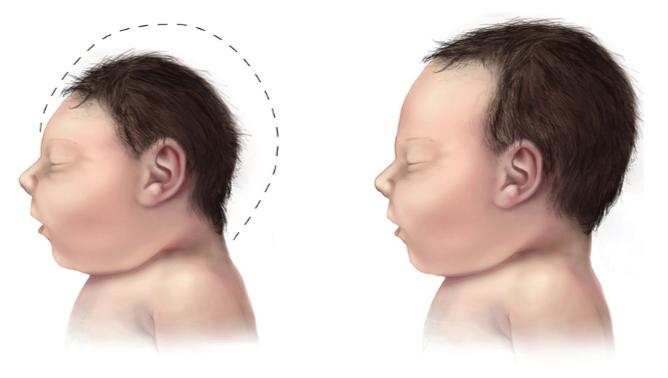 Trẻ sinh non bị teo não khu trú thùy trán 2 bên có cần can thiệp gì không?