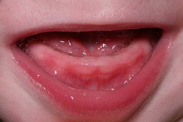 Trẻ hơn 4 tháng chưa mọc răng cửa nhưng nhú một góc răng hàm dưới có sao không?