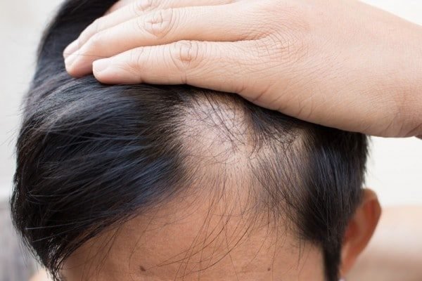 Trẻ bị rụng tóc, lông mày phải điều trị thế nào?