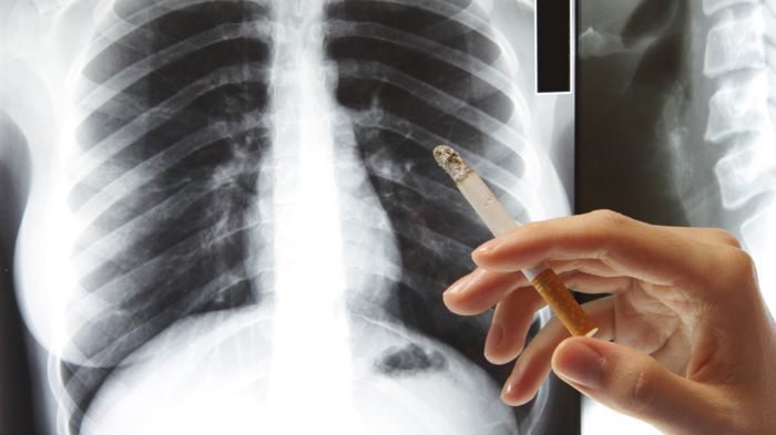 Đã chữa trị lao phổi có hút thuốc lá ít nicotin được không?