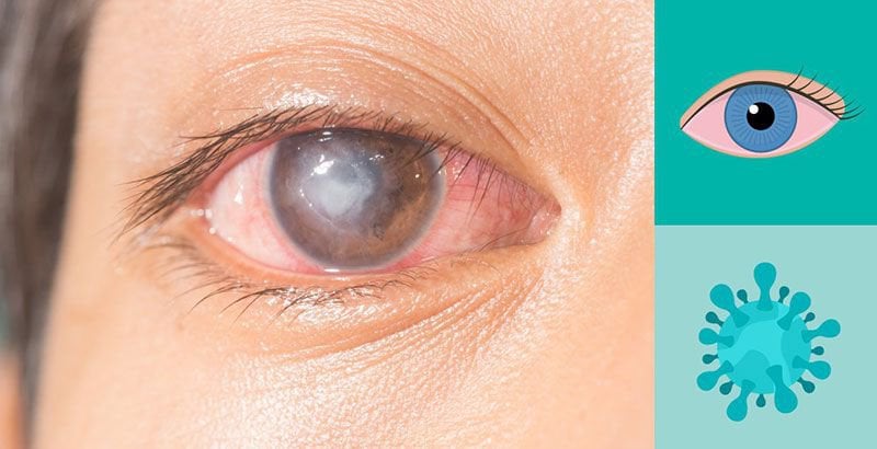 Mắt trẻ bình thường sau 30 ngày điều trị loét giác mạc có cần tái khám nữa không?