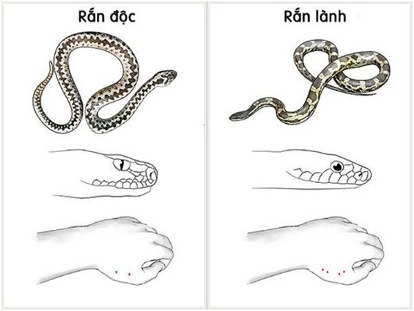 Sơ cứu rắn độc cắn bằng quy trình kỹ thuật băng ép bất động