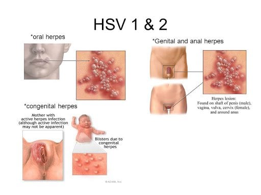 Bệnh Herpes có chữa được khỏi không?