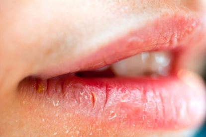 7 lời khuyên của bác sĩ da liễu để chữa lành đôi môi khô nứt nẻ