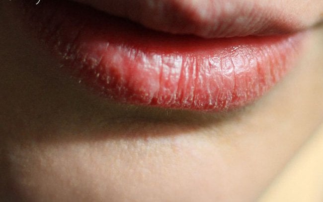 Viêm môi bong vảy chữa trị thế nào?