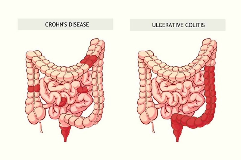 bệnh Crohn