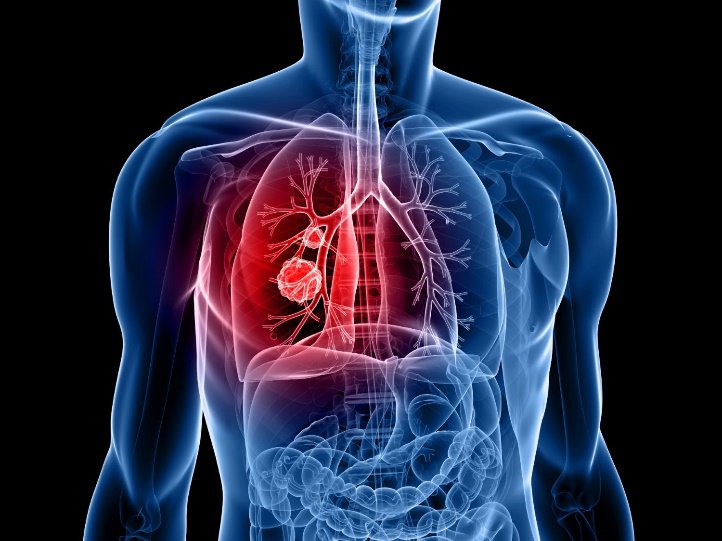 Điều trị ung thư phổi