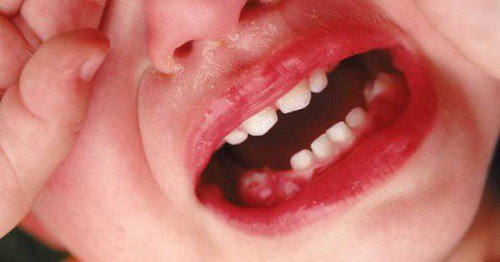 Bé 2 tuổi loét miệng, chảy máu chân răng có nghiêm trọng không?