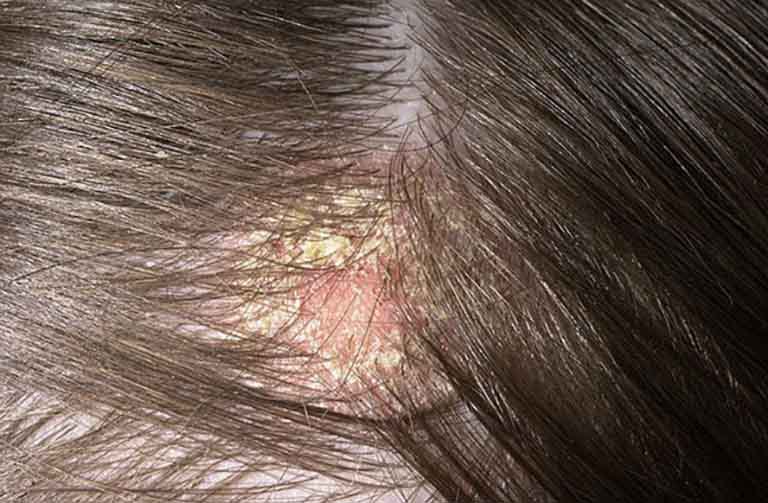 Nấm da đầu nên điều trị như thế nào?