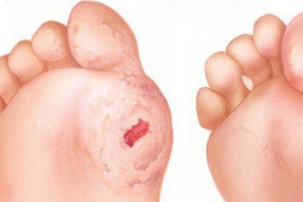 nhiễm trùng bàn chân