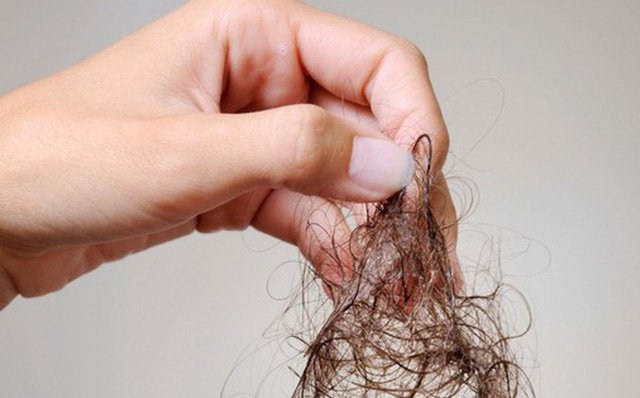 Người bệnh có thể bị rụng tóc khi hóa trị ung thư vòm hầu