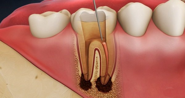Đau tủy răng là một trong các nguyên nhân làm cho răng nhạy cảm dễ bị đau