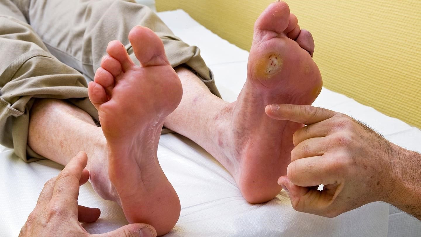 Thuốc Regranex Gel (còn được gọi là Becaplermin) thường được sử dụng để điều trị một số vết loét ở chân ở những người bị bệnh tiểu đường