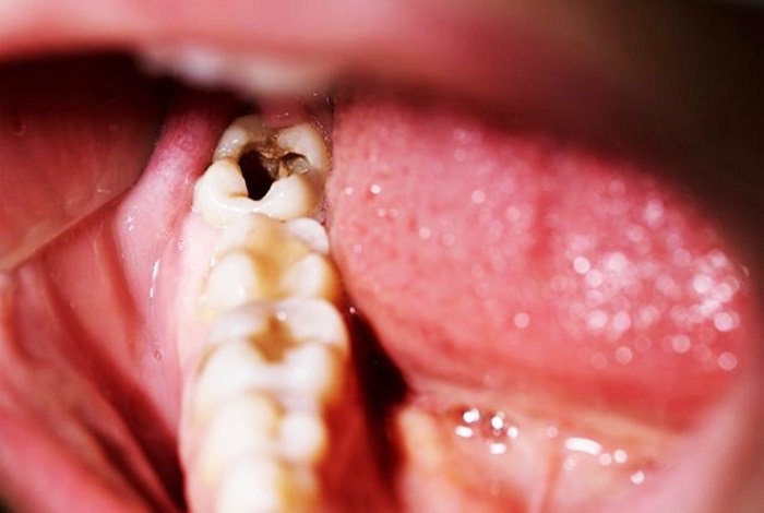 Thuốc Stannous Fluoride được sử dụng để ngăn ngừa sâu răng