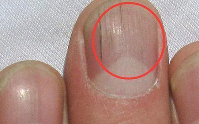 Nổi các vạch đen nâu trên móng tay là bệnh gì?
