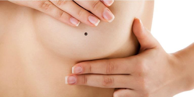 Mọc nốt ruồi ở ngực phát triển nhanh kèm ngứa có phải ung thư không?