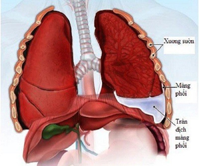 Dày thành phế quản có phải viêm phổi?