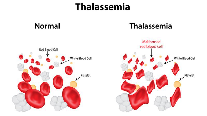 Thalassemia thể nhẹ có thể điều trị được không?