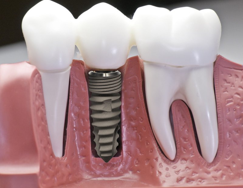răng giả implant