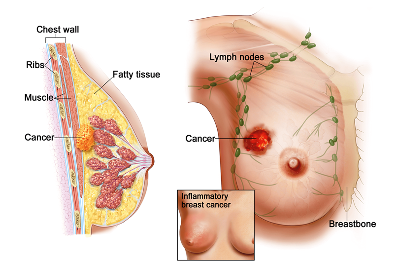 Dấu hiệu nhận biết ung thư vú là gì?