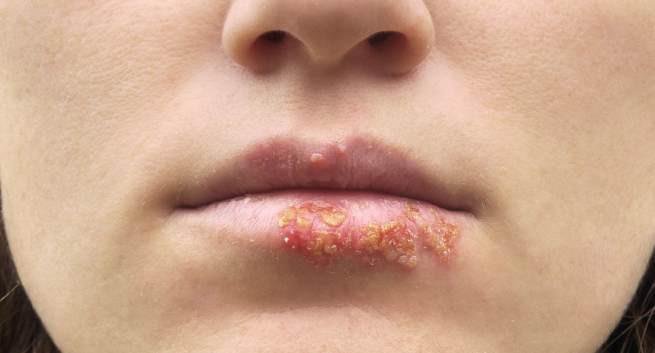 Thuốc Xerese được sử dụng để điều trị mụn rộp, các vết loét do virus herpes simplex gây ra trên môi và xung quanh miệng