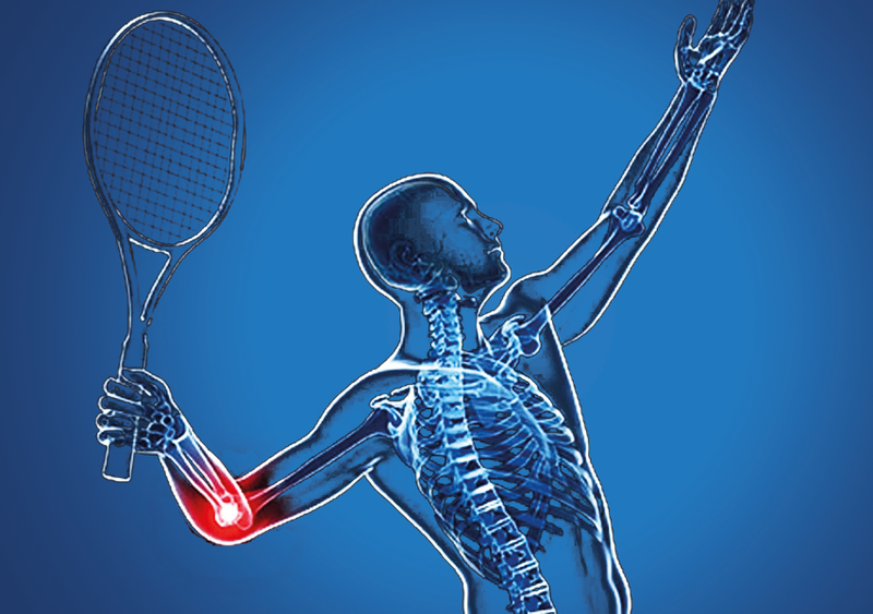 Điều trị hội chứng khuỷu tay tennis như thế nào?