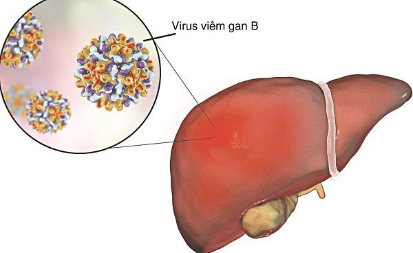 Virus viêm gan B tăng nhiều khi đang dùng thuốc điều trị có sao không?