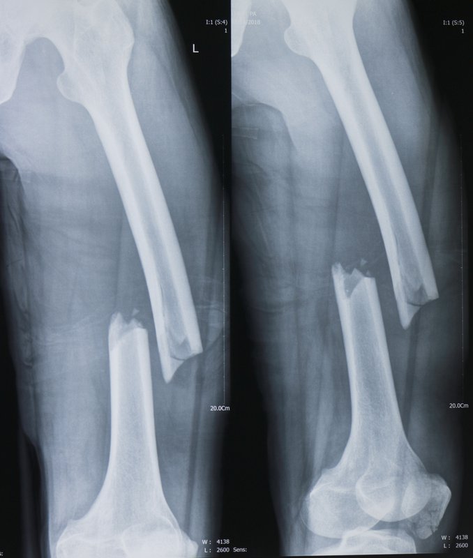 Chân cao chân thấp sau mổ gãy thân xương đùi phải làm gì?