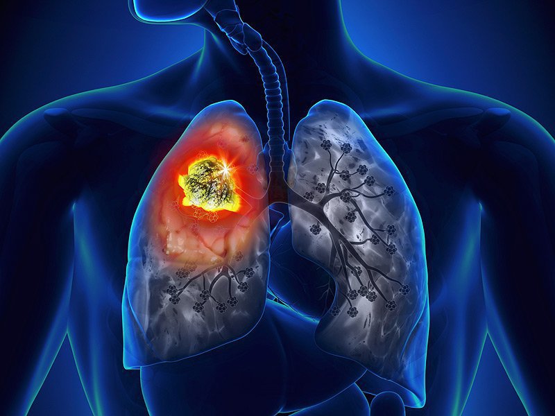 Các loại ung thư di căn đến phổi