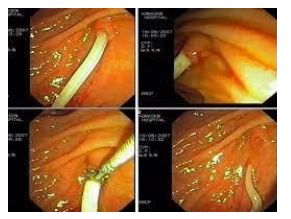 Hình ảnh giun chui ống mật được lấy qua ERCP