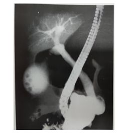 Barium còn đọng ở khung đại tràng che lấp một phần hình ảnh ống mật chủ  vùng nhú Vater