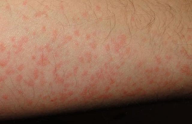 Nổi vết đỏ trên da vào mùa hè là dấu hiệu của bệnh gì?