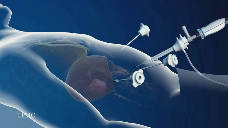 Phẫu thuật nội soi cắt gan thùy trái