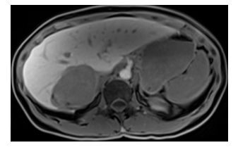 Hình  ảnh T1  một giờ sau khi tiêm tác nhân đặc hiệu tế bào gan (gadobenate dimeglumine): Giảm âm của tổn thương cho thấy đây không phải là khối u tế bào gan.