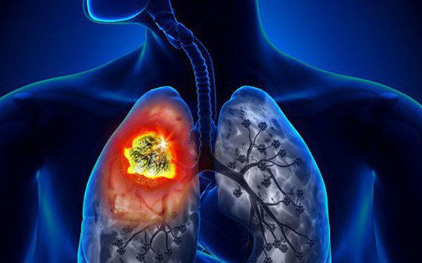 ung thư vú di căn phổi