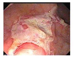 Hình ảnh loét đại tràng do nấm Histoplasma