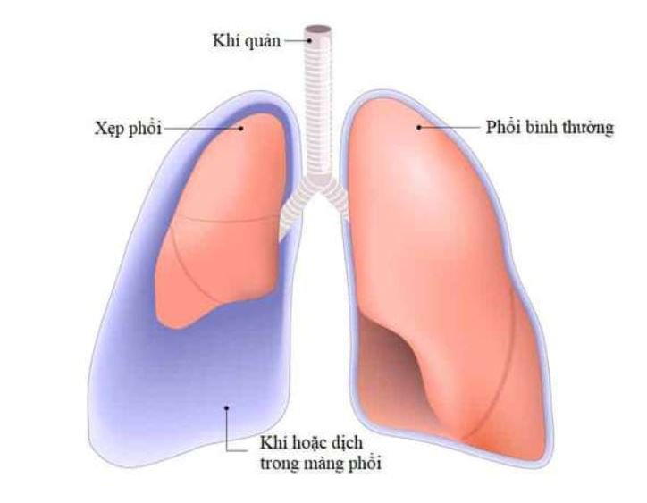 Người bệnh có thể gặp tình trạng đau ngực do tràn dịch màng phổi