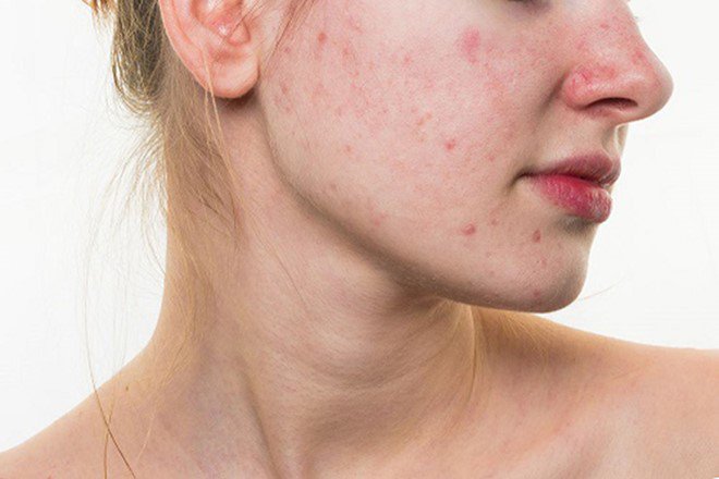 Trị mụn bằng công nghệ Nano Skin có làm da bắt nắng không