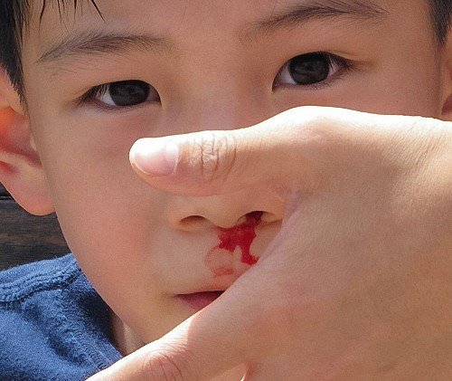 chảy máu mũi ở trẻ em